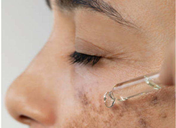Hyperpigmentation