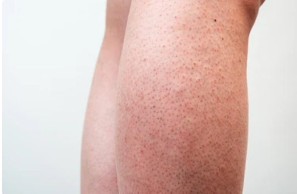 Strawberry Legs